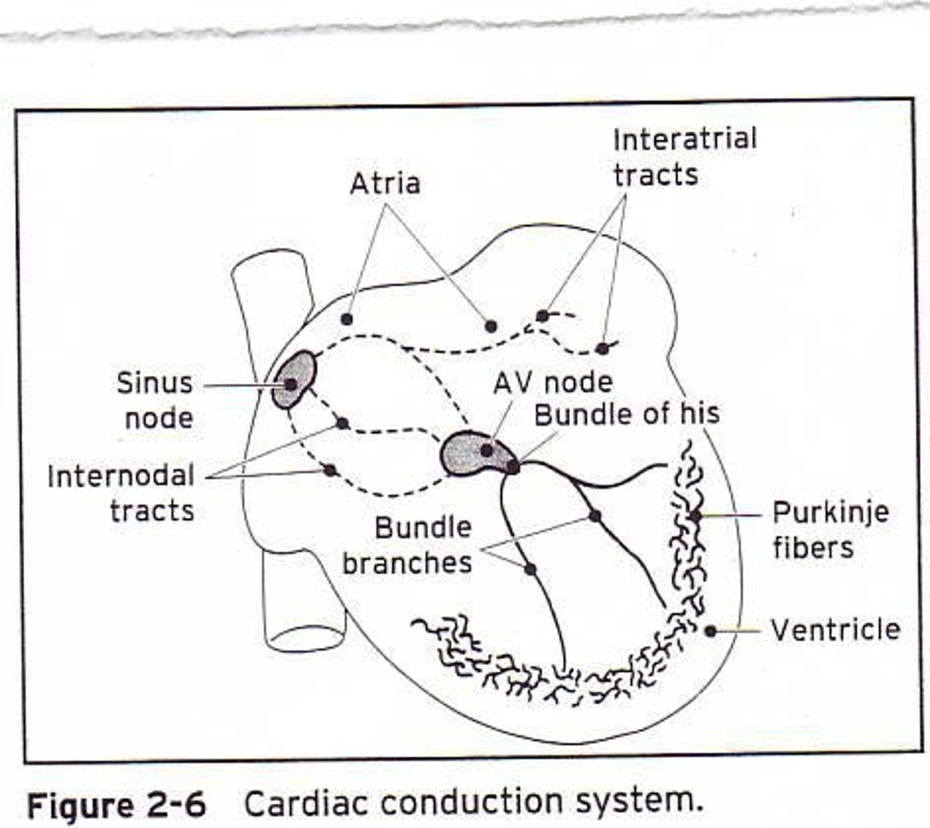 <p>A dysrhythmia is any disturbance in the normal cardiac conduction pathway (P-QRS-T).</p>