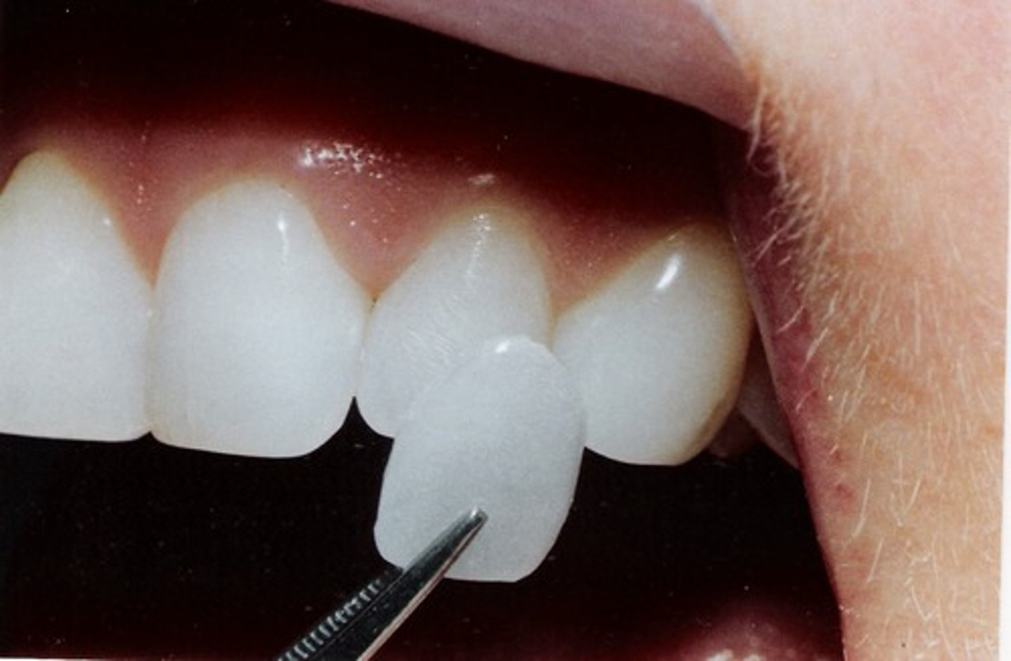 <p>layer of material over a tooth to improve the appearance or protect the tooth from damage.</p><p>The two main types of material used to fabricate a veneer: composite and porcelain.</p>