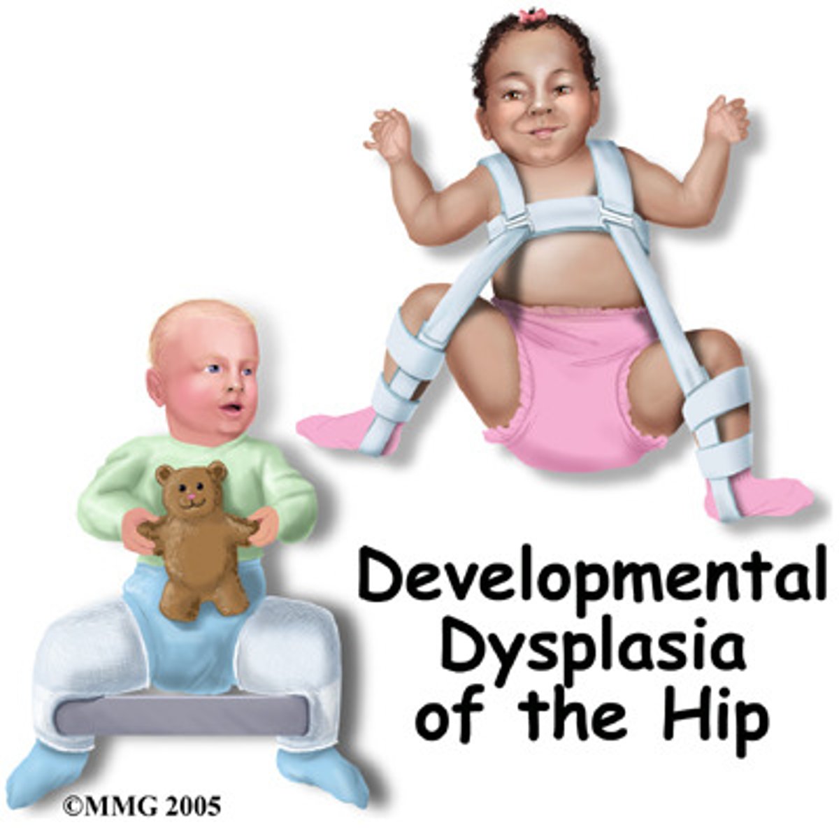 <p>newborns to 6 months old:</p><p>-abduction splint (Pavlik harness)</p><p>-prevents hip flexion and adduction</p><p>-wear for 12 weeks, 23 hours/day</p><p>-want to check the straps and skin integrity</p><p>6 months to 2 years old (if Pavlik harness did not help):</p><p>-surgical reduction and hip spica cast</p><p>-maintains external rotation of the hip</p><p>-want to use a waterproof barrier around the cast to prevent soiling it</p>