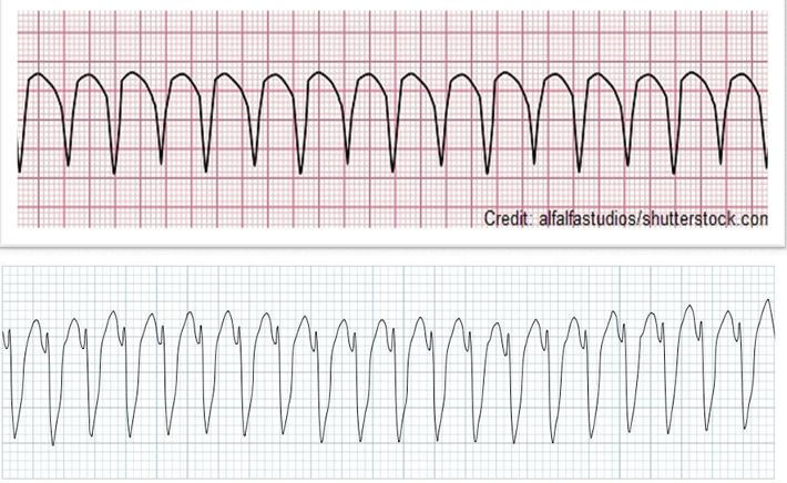 <ul><li><p class=""><strong>Rate</strong>: <em>Atrial</em>: Depends on the underlying rhythm; <em>Ventricular</em>: <mark data-color="yellow" style="background-color: yellow; color: inherit">100 to 200 bpm</mark></p></li><li><p class=""><strong>Rhythm</strong>: Usually regular</p></li><li><p class=""><strong>P Waves</strong>: N/A</p></li><li><p class=""><strong>P to QRS Ratio</strong>: N/A</p></li><li><p class=""><strong>PR Interval</strong>: N/A</p></li><li><p class=""><strong>QRS Complex</strong>: Greater than 0.12 seconds; wild, bizarre, and abnormal</p></li></ul><p>**all are uniform</p>