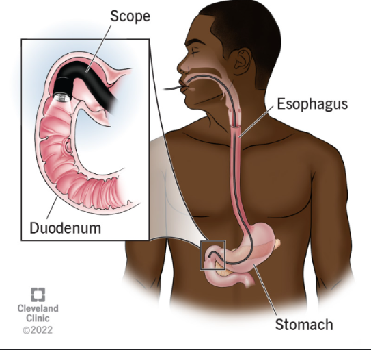 <p>an endoscope is inserted into the esophagus to visualize the lining of the esophagus, stomach, and duodenum. Biopsy specimens and fluid for culture and cytologic analysis may be obtained. Interventions such as polypectomy and vessel obliteration may be performed</p>