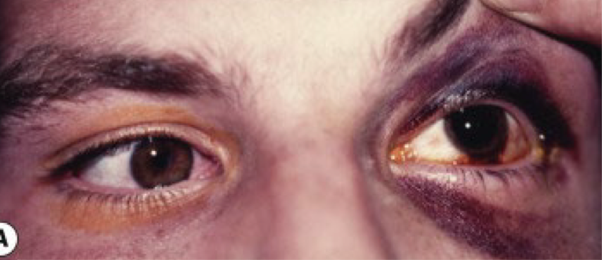 <ul><li><p><span>Medial wall fractures make up 25.2% of all orbital fractures</span></p><ul><li><p><span>Typically associated with orbital floor fractures</span></p></li></ul></li><li><p><strong><span>Presentation</span></strong><span>:</span></p><ul><li><p><span>Periorbital ecchymosis</span></p></li><li><p><span>Subcutaneous emphysema</span></p></li><li><p><span>Medial rectus entrapment will result in limited adduction and abduction</span></p></li><li><p><span>Cerebral spinal fluid rhinorrhea</span></p></li></ul></li><li><p><strong><span>Work up</span></strong><span>: CT scan</span></p></li><li><p><strong><span>Treatment</span></strong><span>:</span></p><ul><li><p><span>Nasal decongestants-individuals are advised to avoid blowing their nose for 14 days post injury</span></p></li><li><p><span>Systemic antibiotics</span></p></li><li><p><span>Systemic corticosteroids for severe edema</span></p></li><li><p><span>Surgical repair: done 2 weeks after initial trauma</span></p></li></ul></li></ul><p></p>