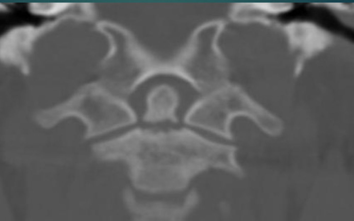 <p>What type of dens fracture is this?</p>
