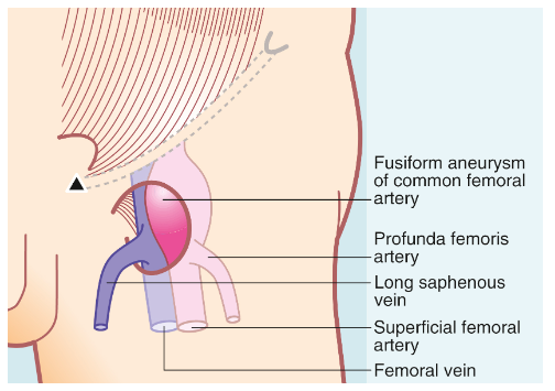 * uncommon as a cause of lumps in the groin
* may occur as part of a generalised aneurysmal disease or isolated
* ==__diagnosis is made on clinical examination; the lump lies below the midpoint of the inguinal ligament and has a characteristic expansile pulsation__==