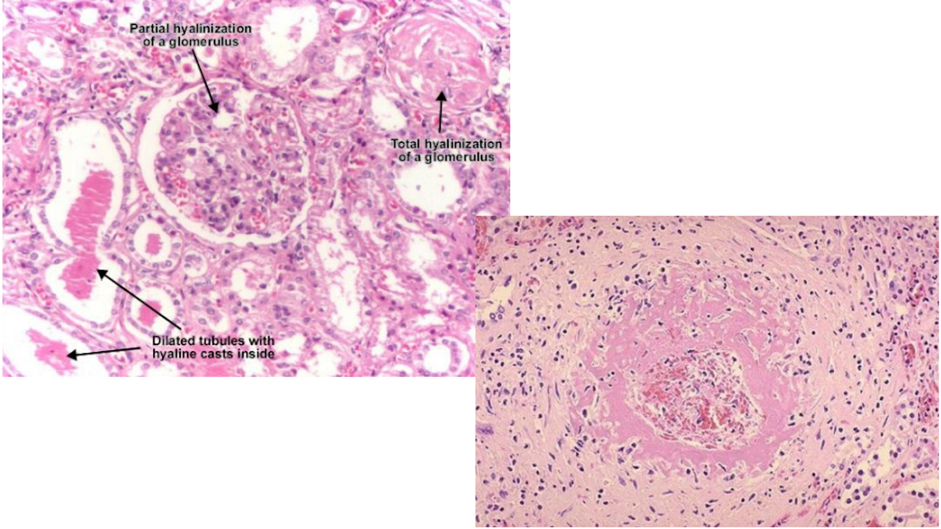 <p>Hyaline Arteriosclerosis</p>