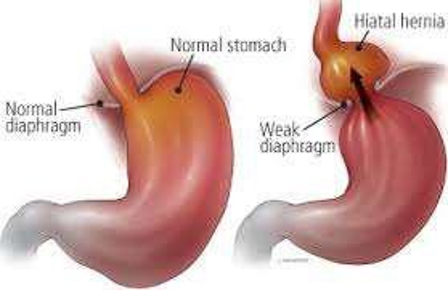 <p>Portion of the stomach protrudes through an opening in the diaphragm.</p>