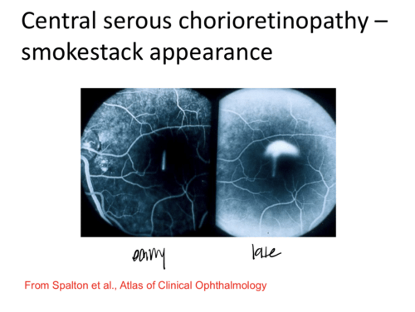 <p>Central Serous Retinopathy -- Smokestack Appearance (Pic)</p>