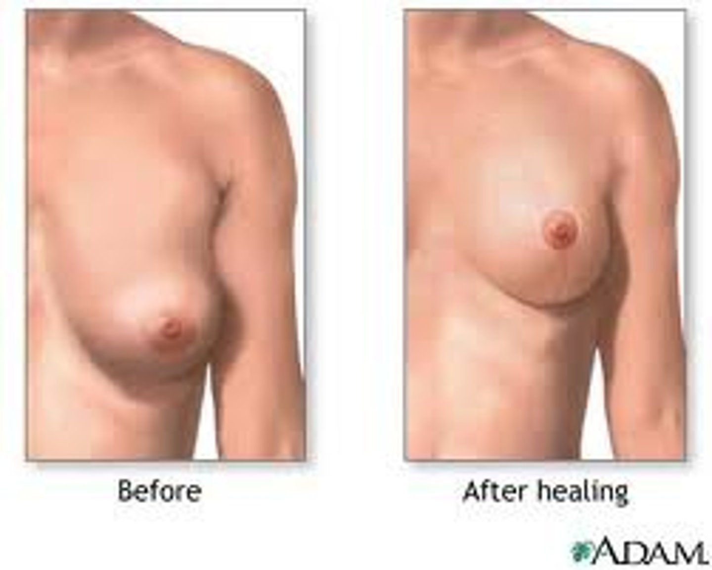 <p>surgical fixation of the breast</p>