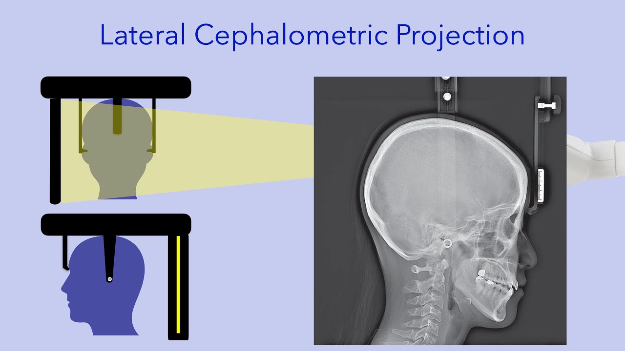 Image receptor is parallel to pts side of interest with beam pointed perpendicular to the receptor

