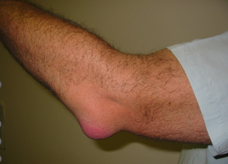 <p>Olecranon Bursa is found superficial to the olecranon process of the ulna, located between the skin &amp; bone. Usually a result of </p>