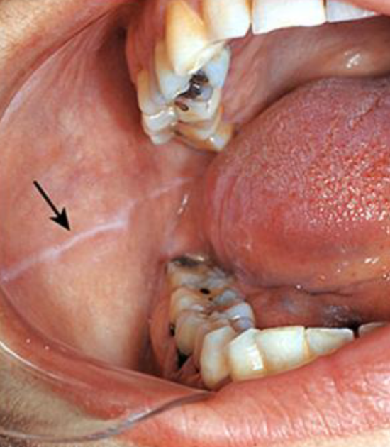 <p>prominent in CLENCHING/BRUXING pts </p>