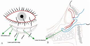 <p>-horizontal incision is given along the level of the lower border of the tarsal plate and exposure of the lower eyelid retracors which are then shortened</p><p>everting sutures are placed to prevent overriding</p>