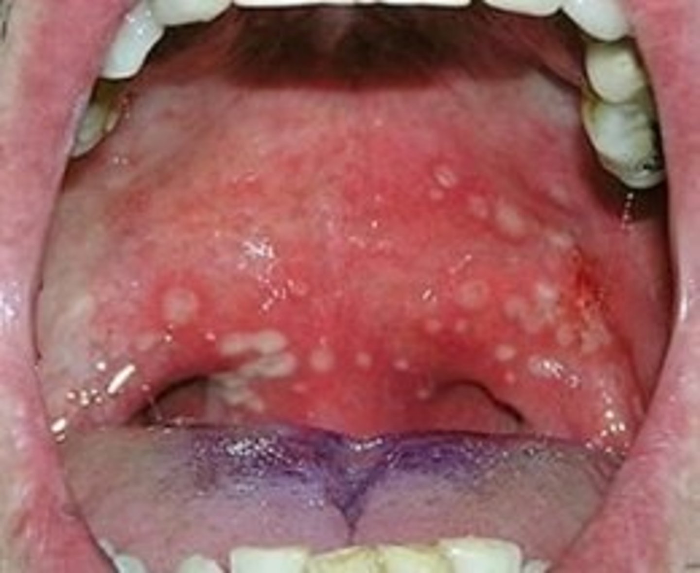 <p>Vesicles on the soft palate along with fever, malaise, sore throat, dysphagia, and</p><p>erythematous pharyngitis</p>