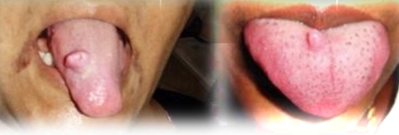 <p><strong><u>Neurofibroma</u></strong></p><p class="has-focus">Neurofibromatosis is autosomal dominant trait with neurofibromas, Cafe-a-lait macules, axillary freckling and lisch nodules on iris.</p><p class="has-focus">5% malignant transformation of syndrome type</p><p class="has-focus is-empty"></p><p class="has-focus is-empty"><strong>Treatment </strong>- Surgical excision if solitary lesion, Selective excision of syndrome type.</p><p class="has-focus"></p><p class="has-focus is-empty"><em>DD - Neurilemmoma, Mucosal neuroma, Irriation fibroma, Benign submucosal neoplasm, Salivary gland neoplasm</em></p>