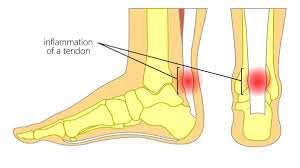 inflammation of a tendon due to injury or over use
