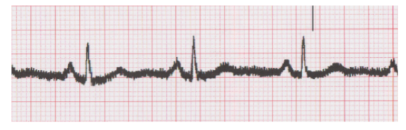 <p>in electrocardiography, a type of artifact caused by the presence of other appliances or equipment in the area surrounding the EKG machine</p>