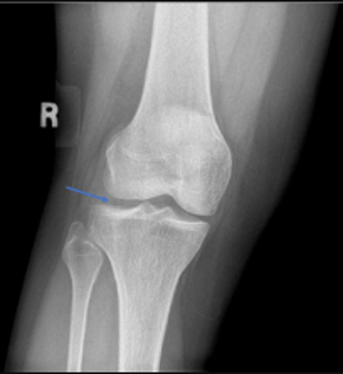 <p>What joint space is the arrowing pointing to?</p>