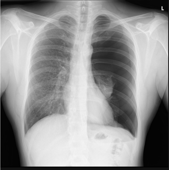 <p>18 y/o male patient presents to the ER with chest pain and shortness of breath. While conducting a physical you note diminished breath sounds on the ENTIRE left side as well as decrease tactile fremtitus. Vitals are stable with the exception of tachycardia. CXR looks like this. What is your treatment plan?</p>