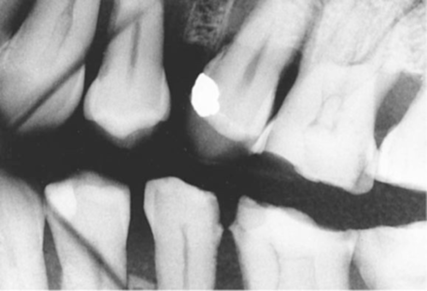 <p>-A thin radiolucent line is seen</p><p>-Film was creased and the emulsion cracked</p><p>-To prevent do not bend or crease the film, instead gently soften the corners before placing in the patient's mouth</p>