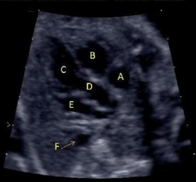 <p>what is letter E</p><p>a) left ventricle</p><p>b) LVOT</p><p>c) RVOT</p><p>d) right atrium</p><p>e) left atrium </p>