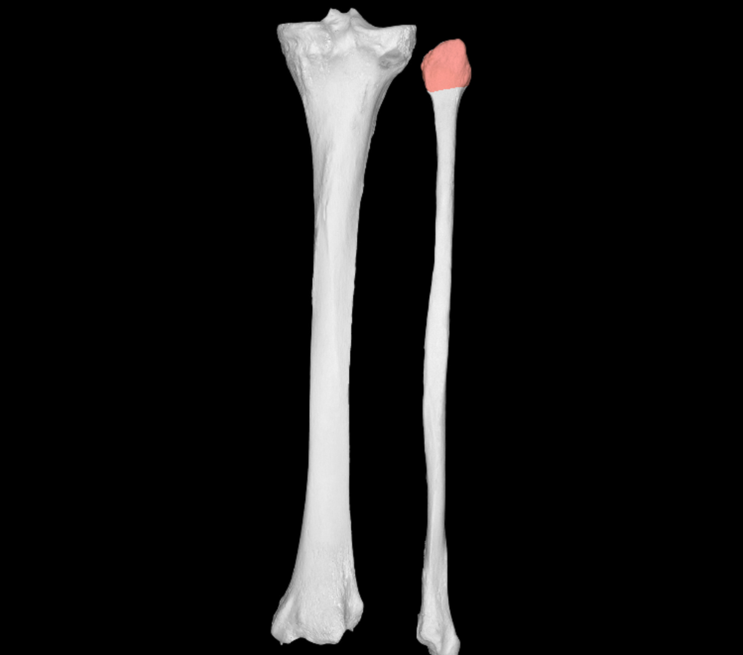 <p>rounded section of proximal end of fibula </p>