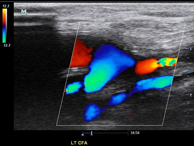 <p>The distal anastomosis of a fem-fem graft is demonstrated. Which of the following statements correctly describe the findings?</p>