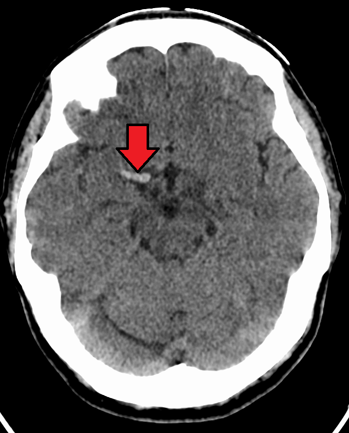 <p>Should CTA proceed if a hyperdense artery is seen but no bleed is present?</p>