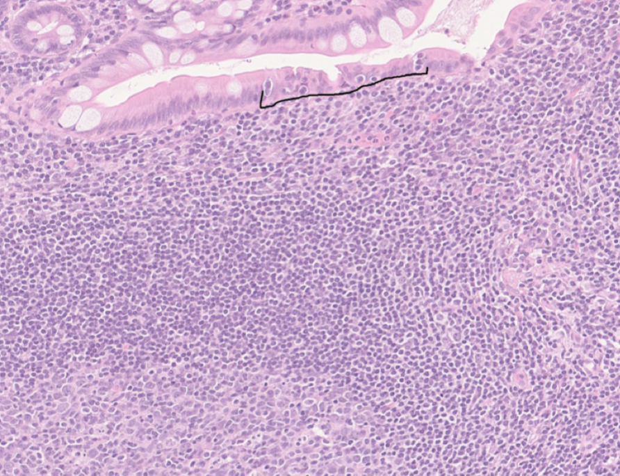 <p><strong>M-celler</strong> finns ovanför peyerska plack och släpper igenom lymfocyter till lumen. </p>