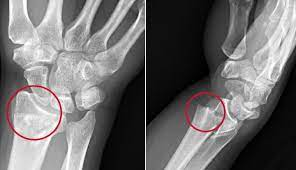 <p>Transverse fracture through the distal radius with dorsal (posterior) angulation. Common for ulnar styloid to fracture, too</p>