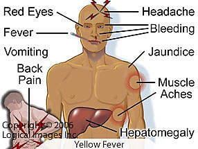 <p><strong>Black vomit</strong> due to GI hemorrhage</p>
