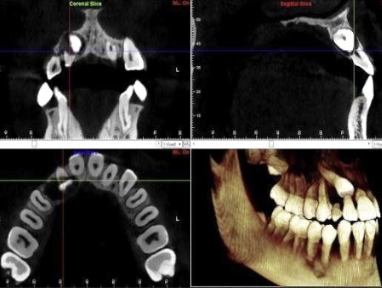 <p>It has demonstrated clinical efficacy in treatment planning for impacted maxillary canines, unerupted teeth, severe root resorption, severe skeletal discrepancies</p>
