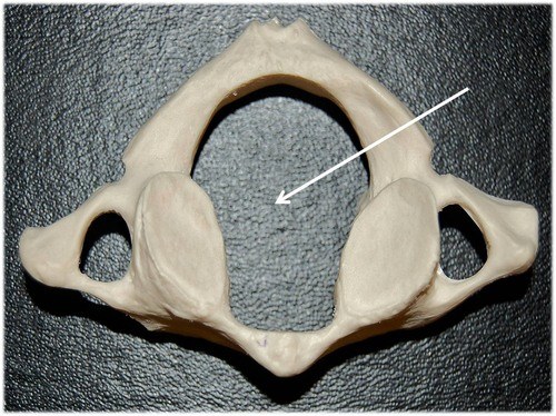 <p>Opening enclosed by the body and vertebral arch; a passageway for the spinal cord</p>