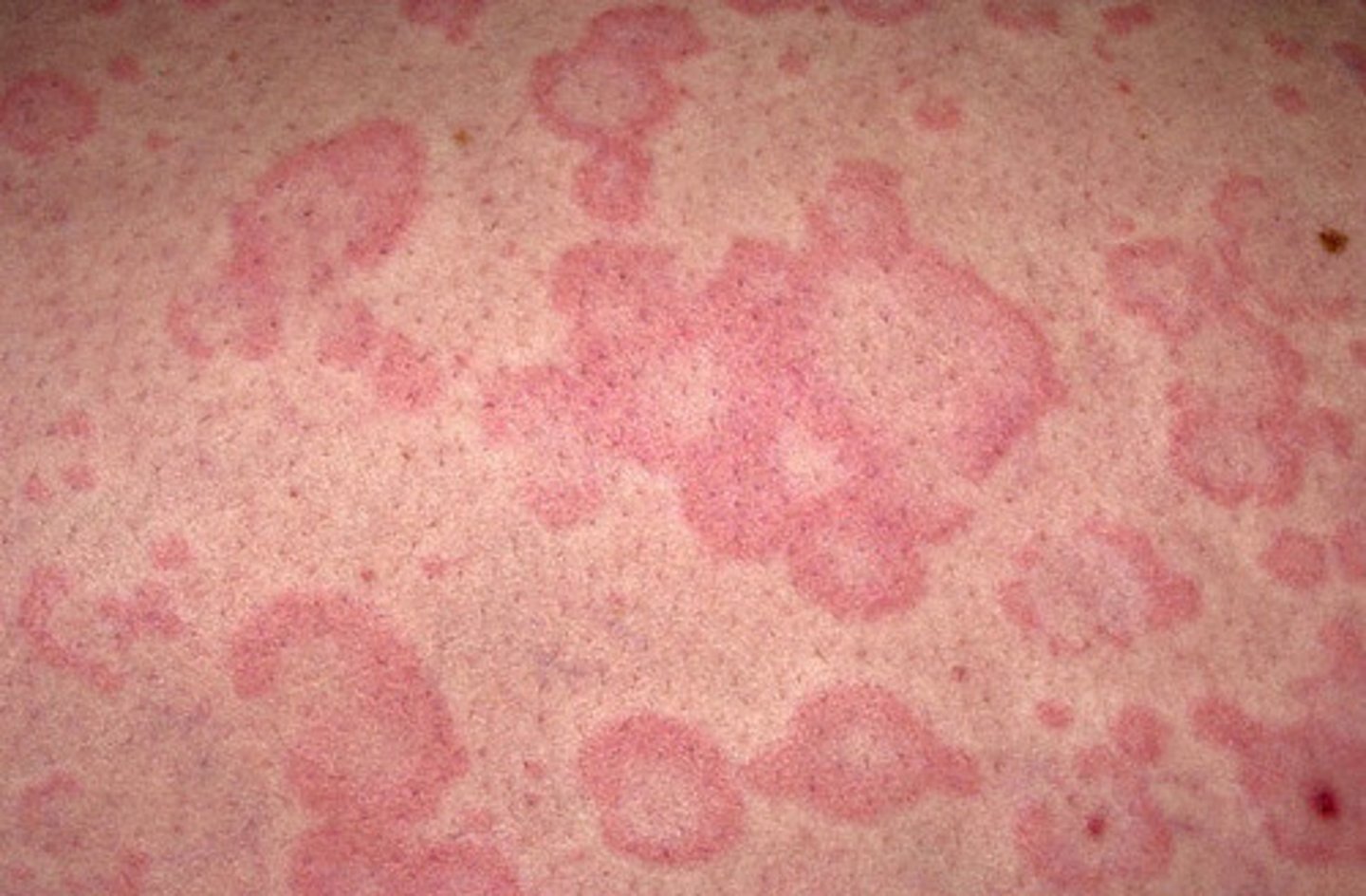 <p>Blanchable, edematous, pink papules/wheals (evanescent - move around/fade <24hrs)</p>