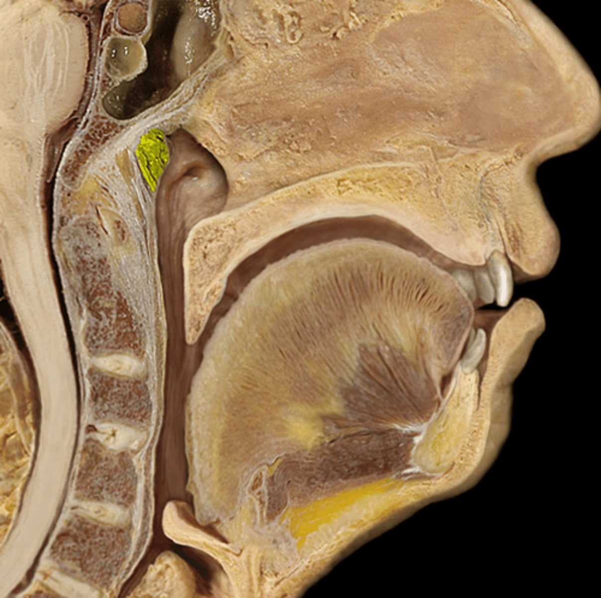 <p>single tonsil on wall of nasopharynx</p>