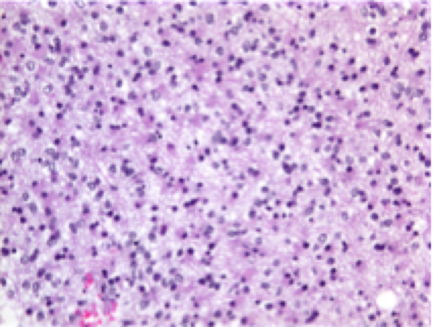 <p>a type of brain tumor that originates from astrocytes, with no pleomorphism present</p>