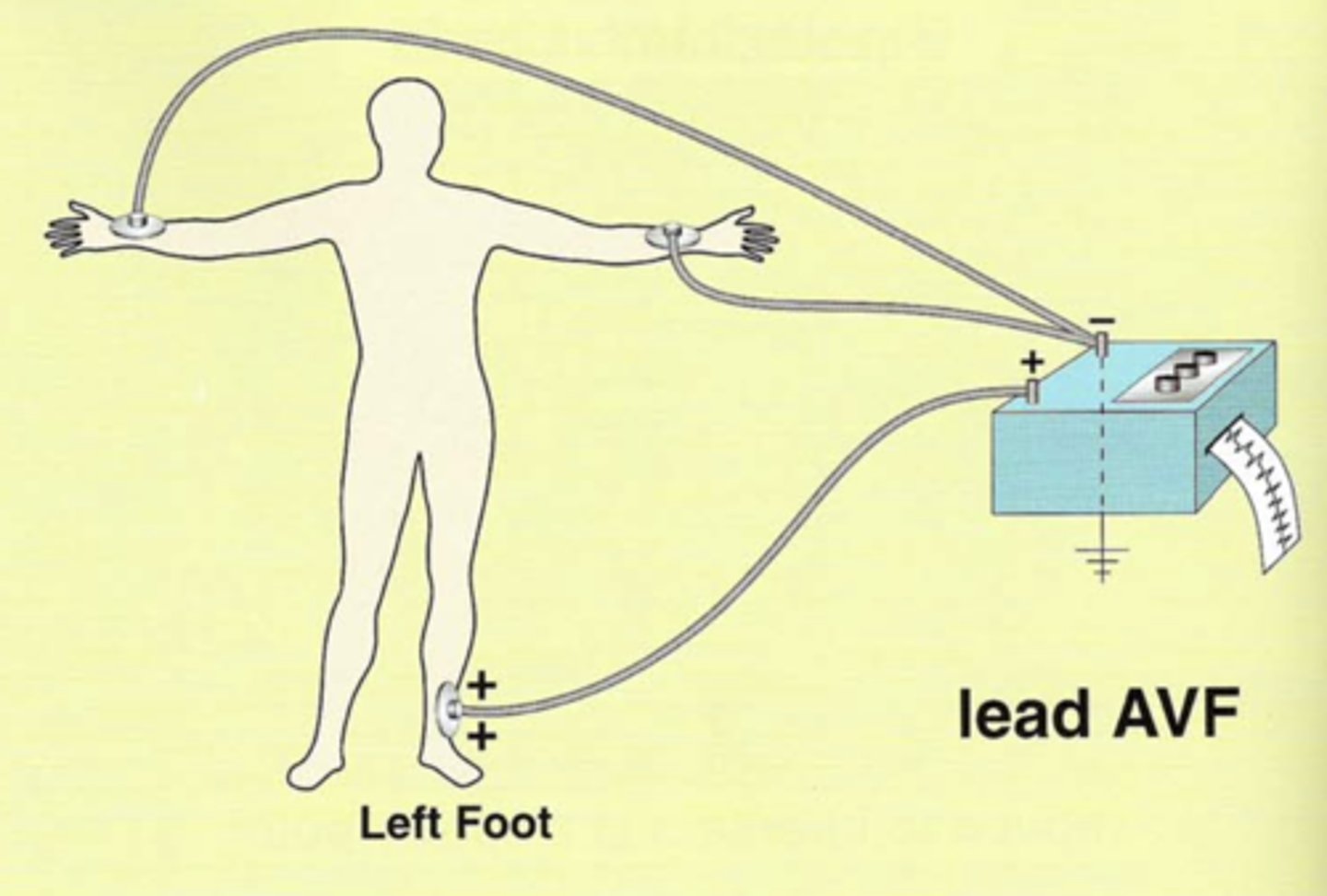 <p>Augmented/amplified, Voltage, left Foot</p><p>Left foot electrode is positive.</p><p>Combination of leads II and III.</p><p>The remaining two are negative.</p>