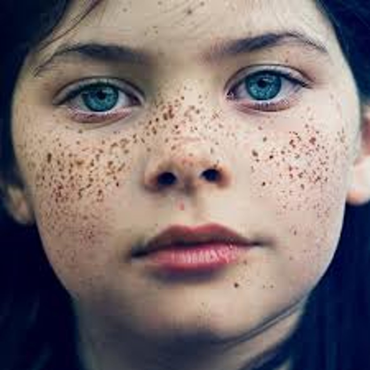 <p>known as freckles. tiny, round or oval pigmented areas of skin on areas exposed to the sun</p>