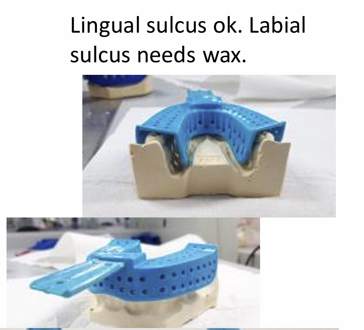 <p>lingually it fits ok with a small gap for the alginate</p><p>labially, there is a gap between edge of the tray and deepest part of the sulcus so wax is needed </p>