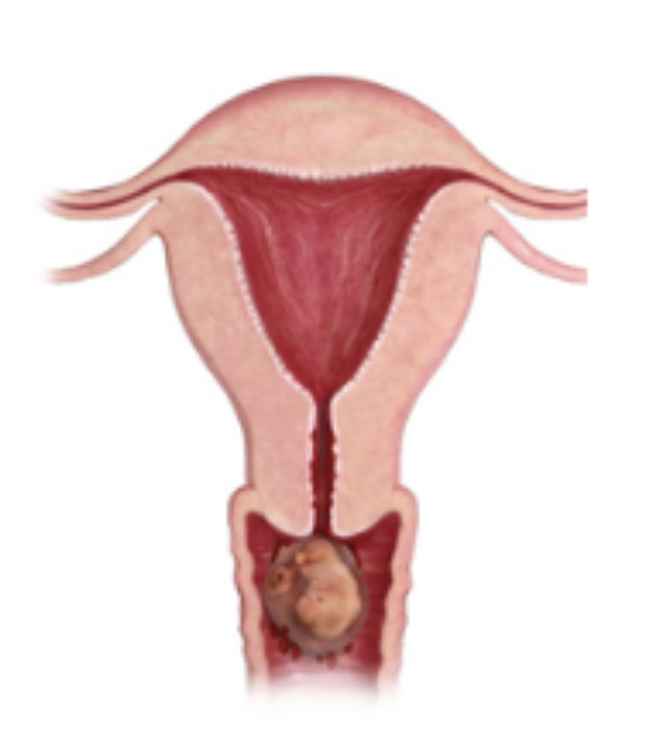 <p>Which type of abortion is characterized by a lack of embryonic/fetal development without cardiac motion on U/S <span style="color: #fe0000">with complete evacuation of the uterus</span></p>