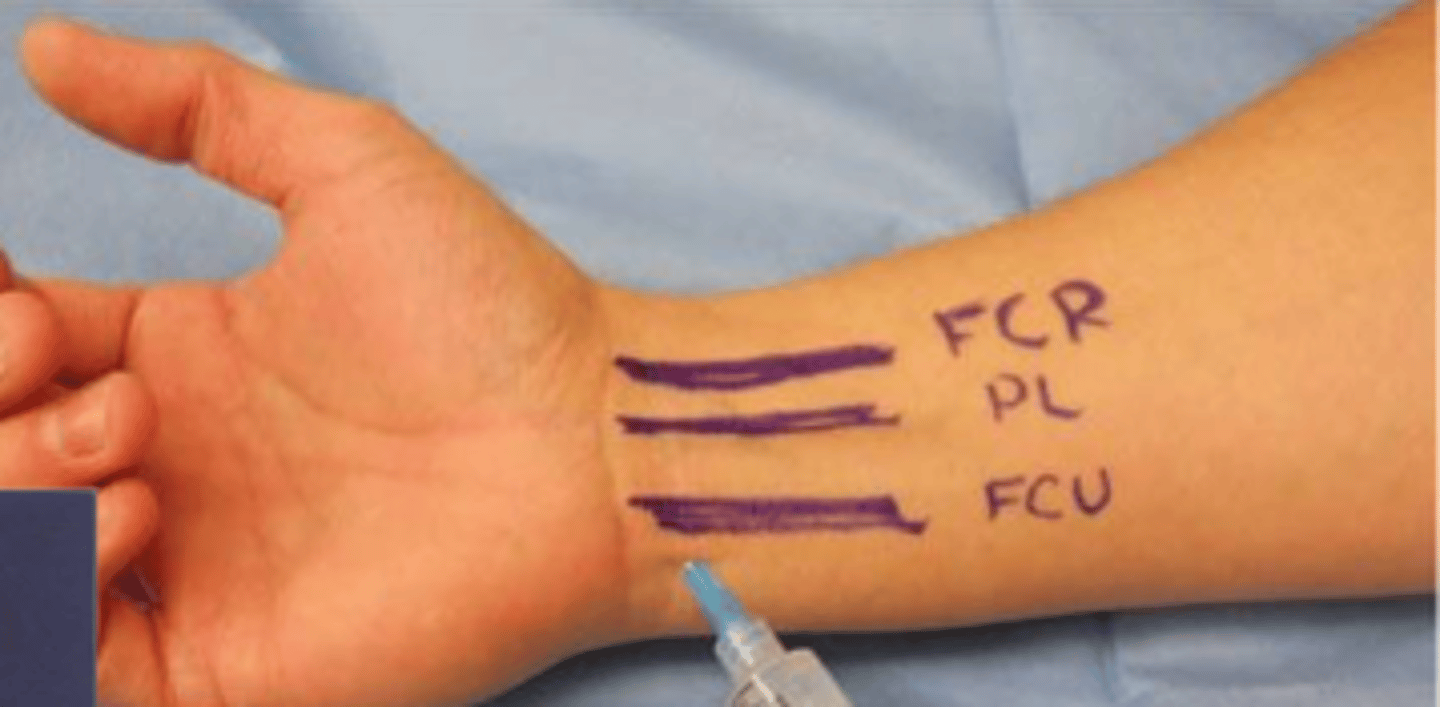 <p>- m. flexor carpi radialis > II. MC vonalában, flexiókor</p><p>- m. palmaris longus </p><p>- m. flexor carpi ulnaris > pisiforme, os hamatum, V. MC vonala</p>