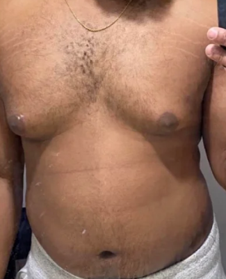 <p>what is a benign growth of breast tissue in males when estrogen levels are greater than testosterone that feels like a smooth, firm, movable disk?</p><ul><li><p>occurs normally during puberty and is temporary </p></li><li><p>occurs in adult males with Cushing’s, adrenal disease, liver cirrhosis, hyperthyroidism, and multiple drugs (alcohol, steroids, cancer treatments)</p></li></ul>