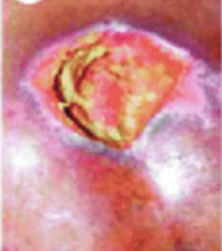 <ul><li><p>area of tissue necrosis</p></li><li><p>caused by prolonged soft tissue compression </p></li><li><p>Local ischemia, moisture </p></li><li><p>Multi morbid and elderly </p></li></ul><p></p>