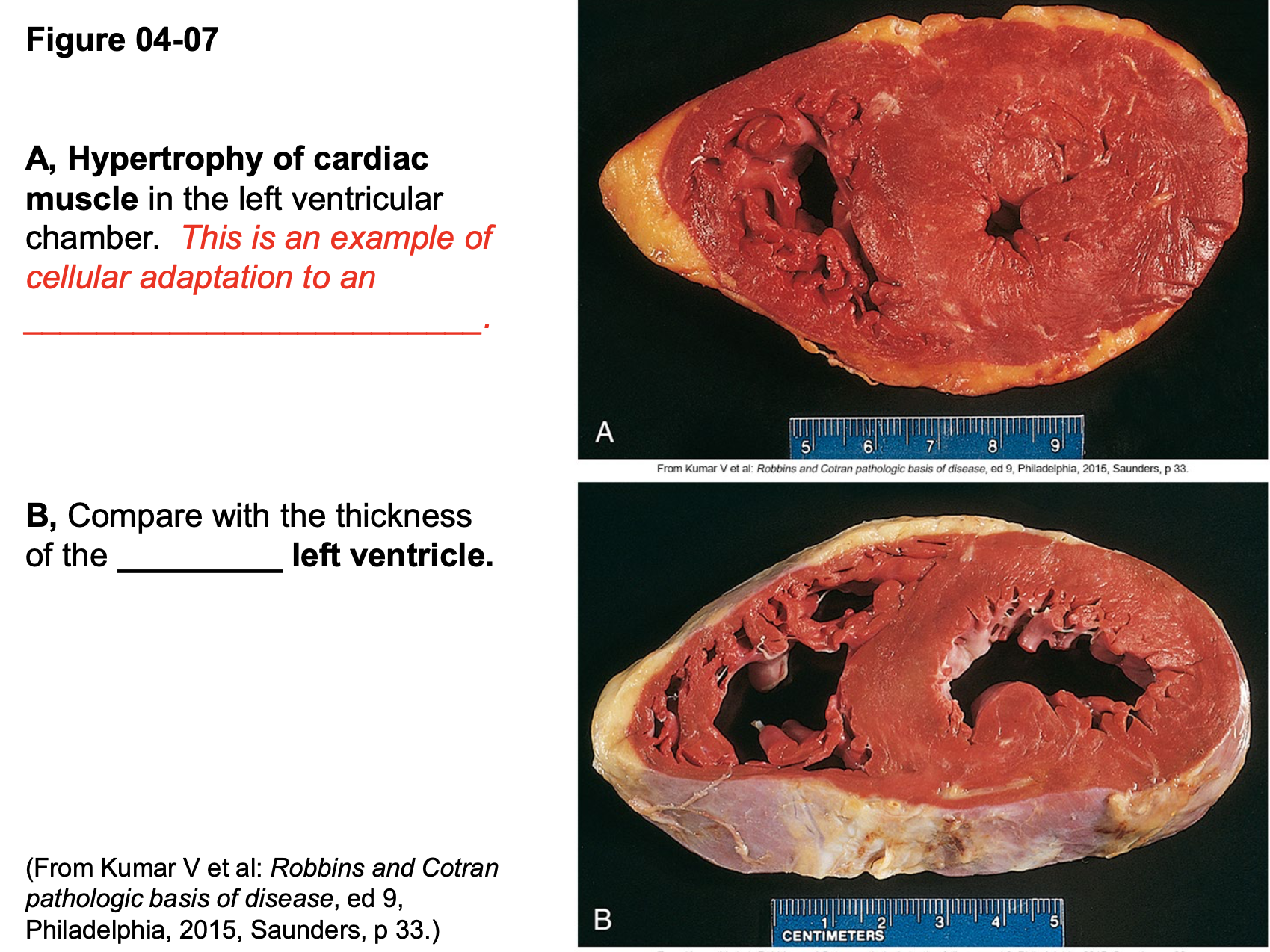 <p>physiologic is normal /heart structure </p><p>pathologic un-regular </p>