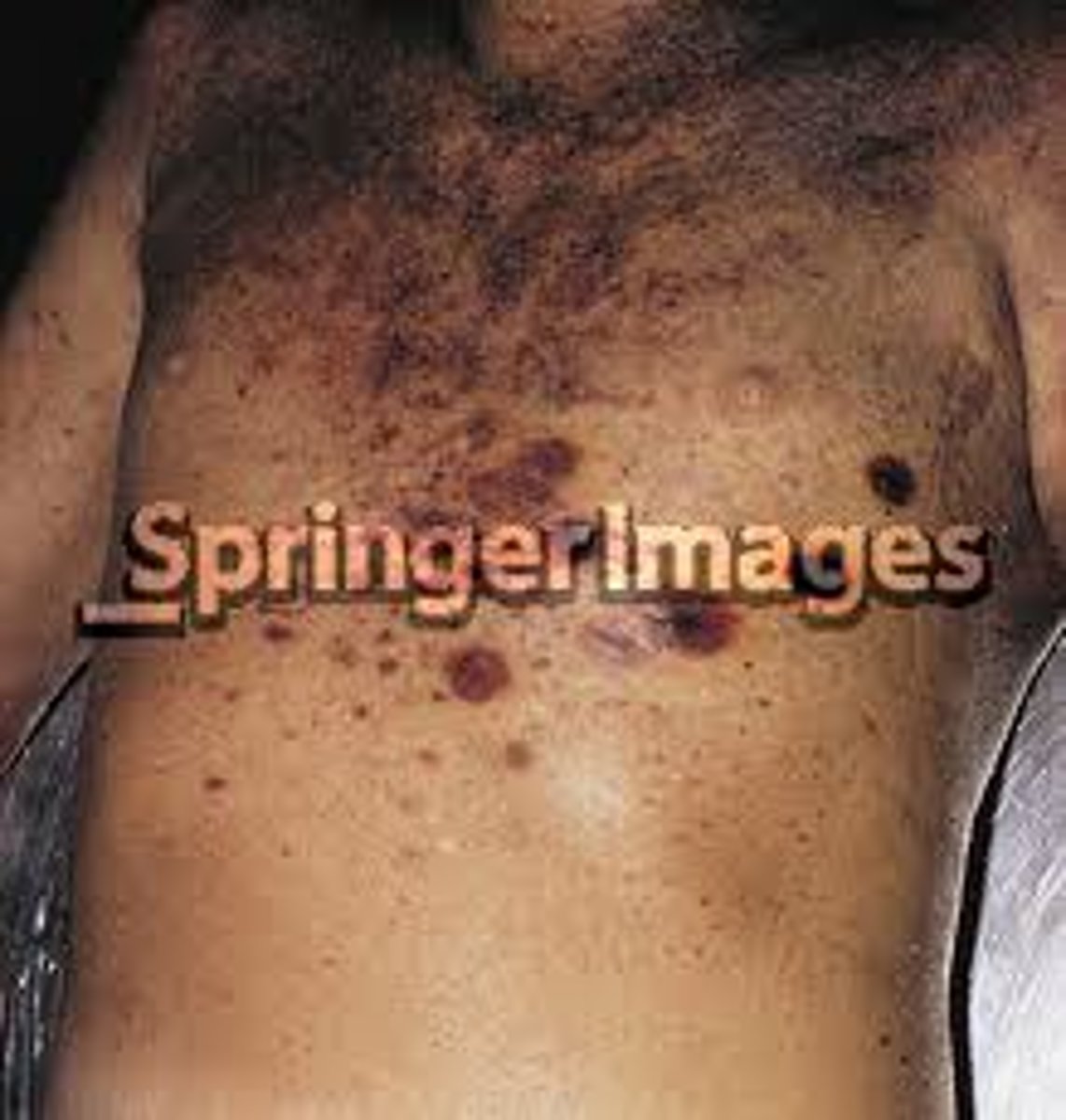 <p>necrotic patches in skin in cancer Pt. d/t</p>