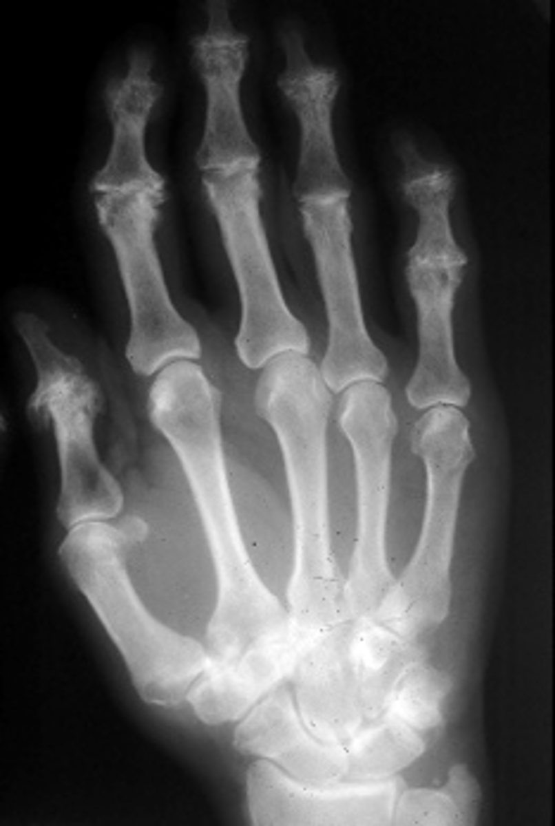 <p>With osteoarthrosis of the hand, what radiographic feature is present in the proximal interphalangeal joints?</p>