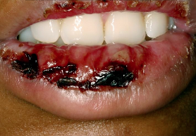 <p>What is Erythema Multiforme (EM)?</p>