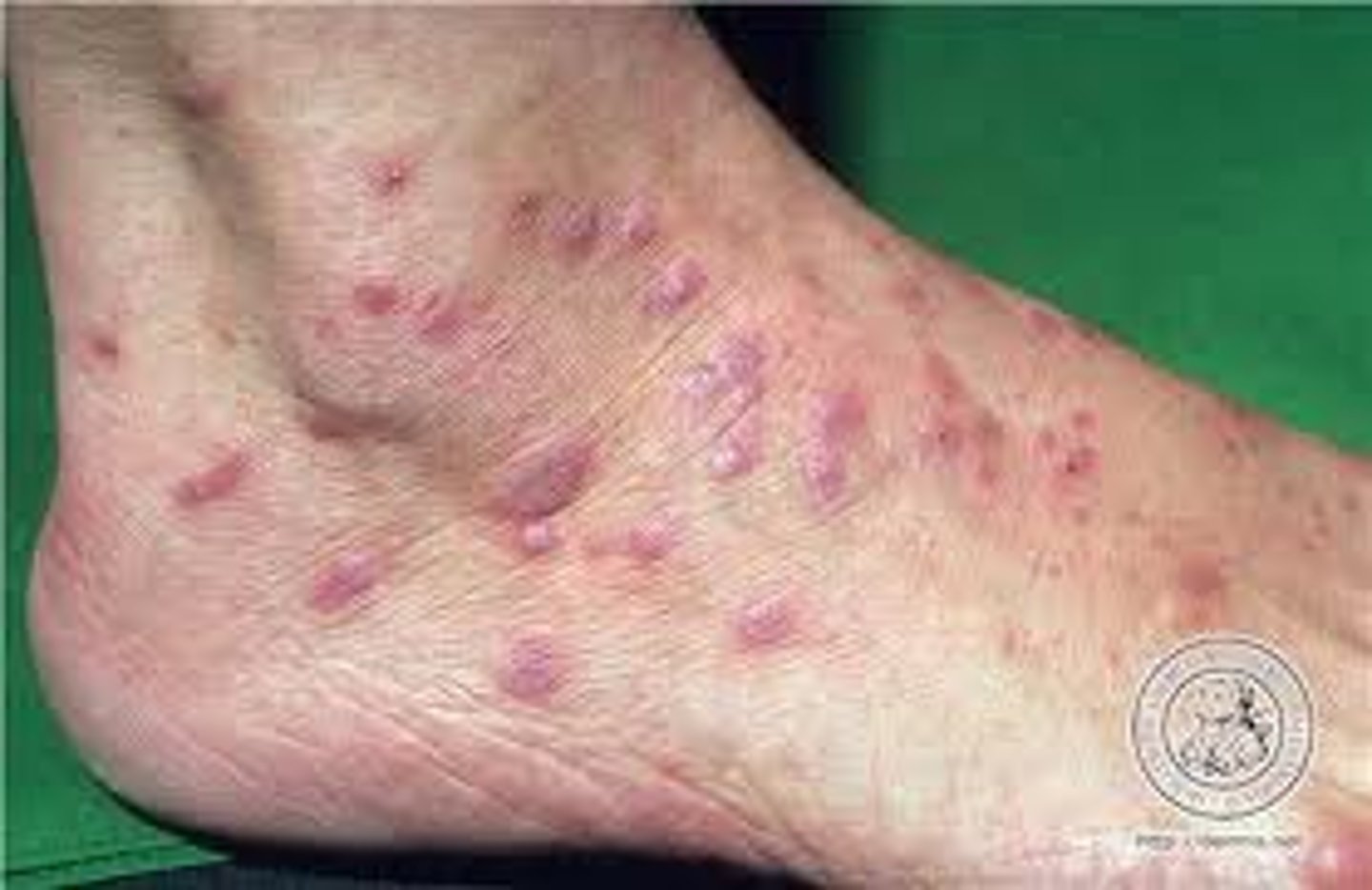 <p>dx: lichen planus</p><p>tx: 1st line topical corticosteroids + antihistamines for itching; 2nd line po steroids, UVB therapy, retinoids</p>