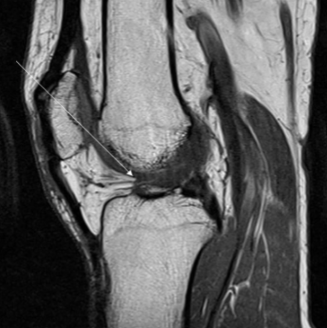 <p>Describe the pathology indicated by the arrow (Sag PD). </p>