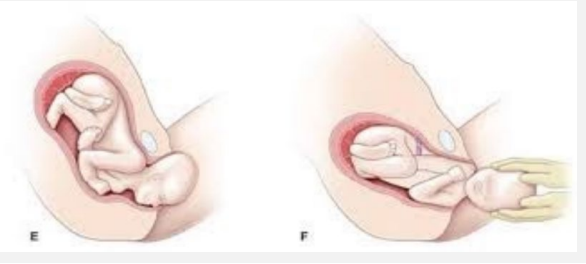 <p><strong>Cardinal Movements: External Rotation</strong></p><p>-Once the ____ delivers, _________ rotation by which the head turns back to prior transverse position occurs and the __________ may be delivered followed by fetal ____</p>