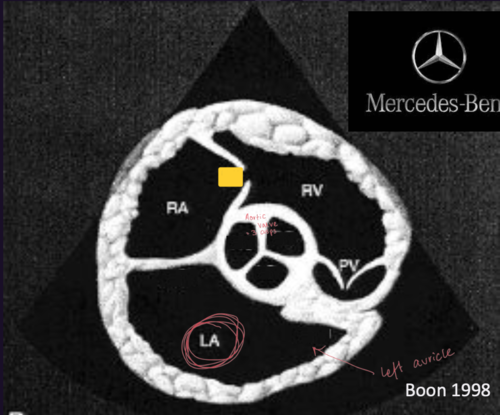 <p>Right Parasternal Short Axis View&nbsp;</p>